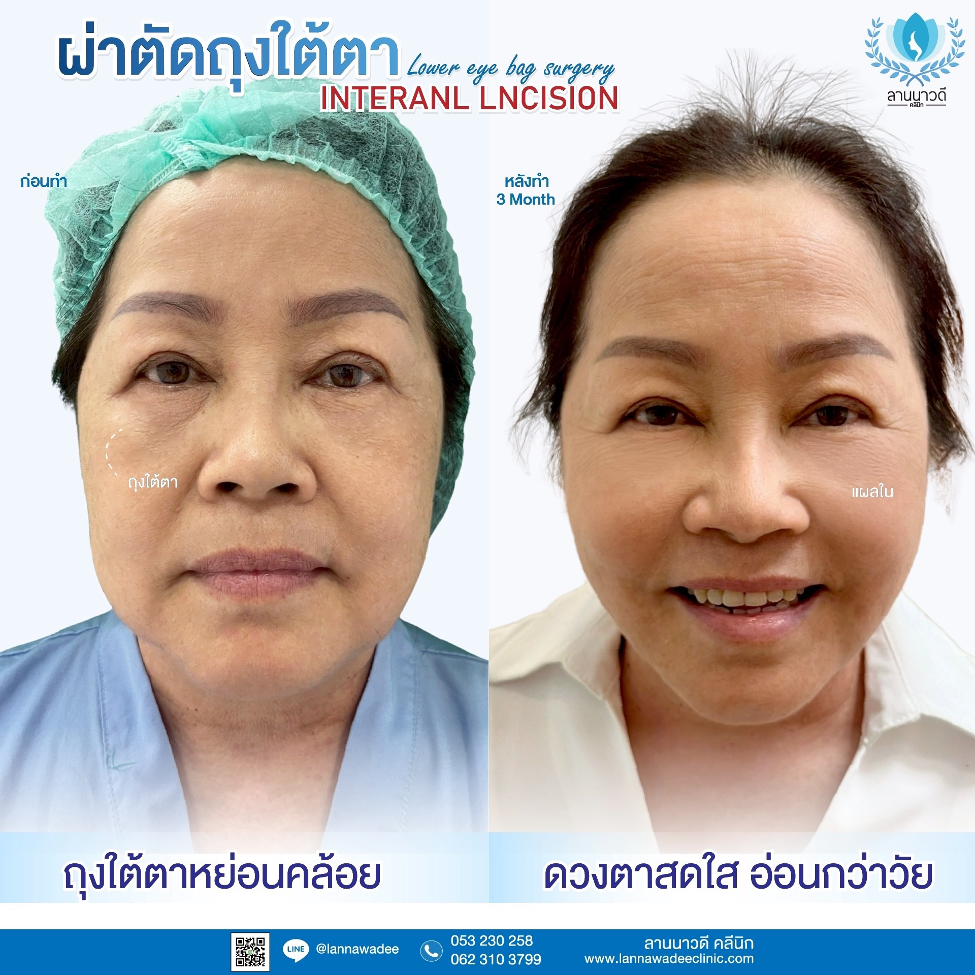 ผ่าตัดถุงใต้ตาเชียงใหม