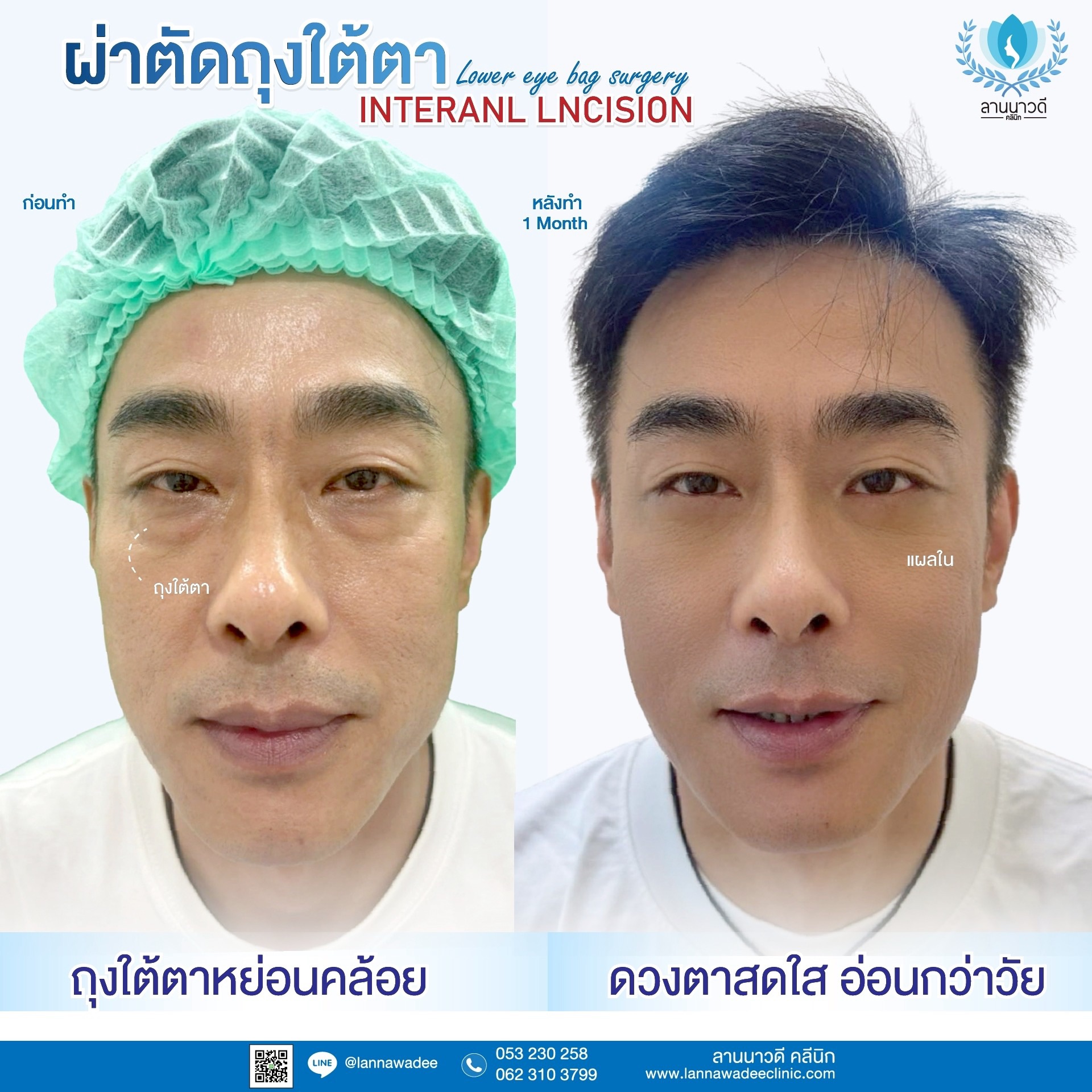 ผ่าตัดถุงใต้ตาเชียงใหม