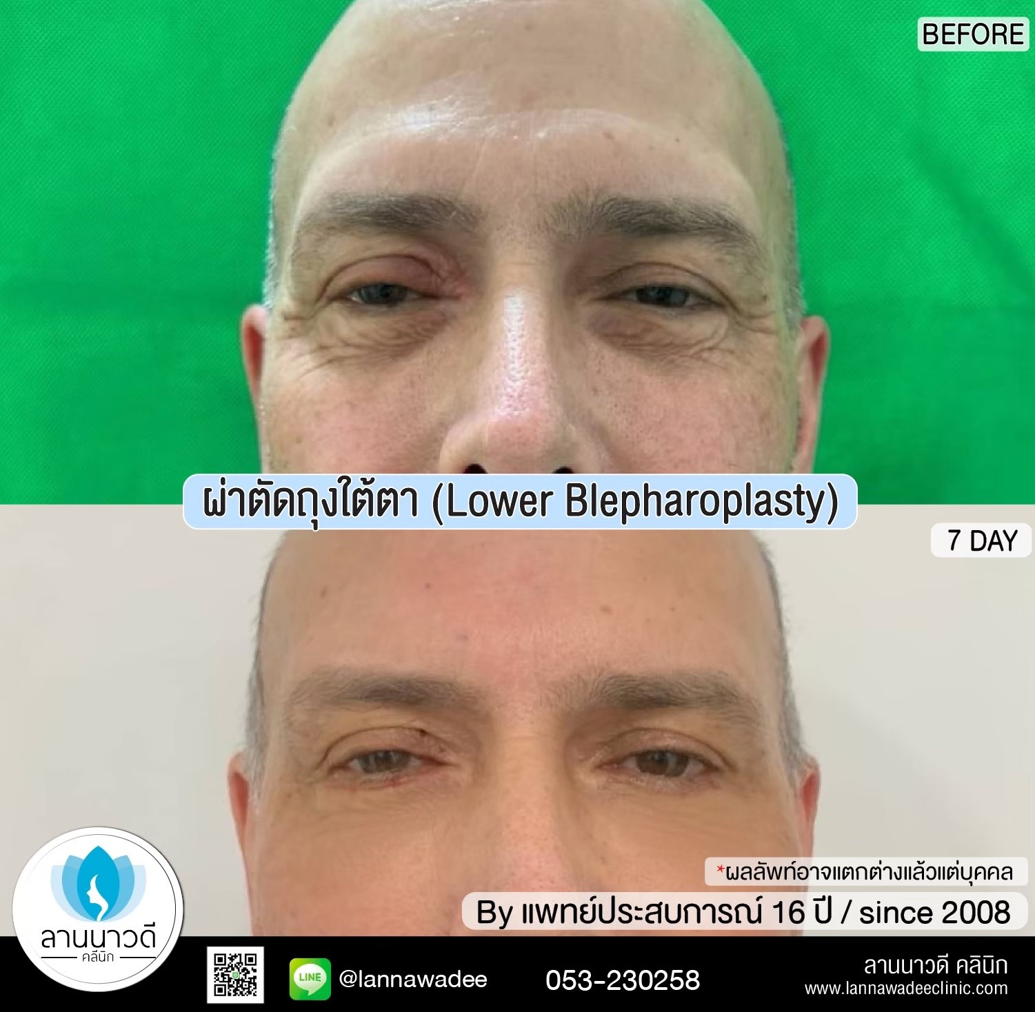 ผ่าตัดถุงใต้ตาเชียงใหม