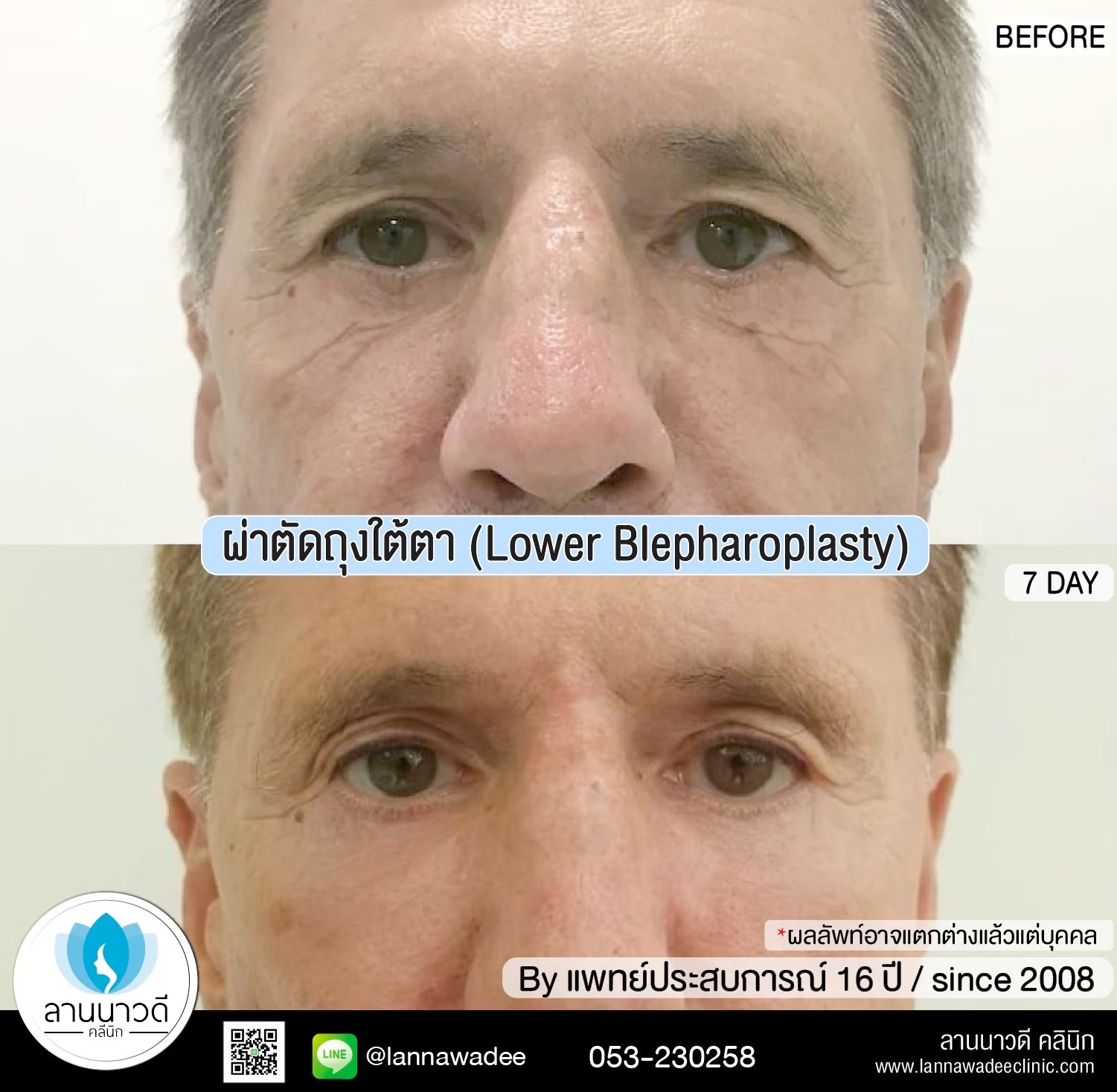 ผ่าตัดถุงใต้ตาเชียงใหม